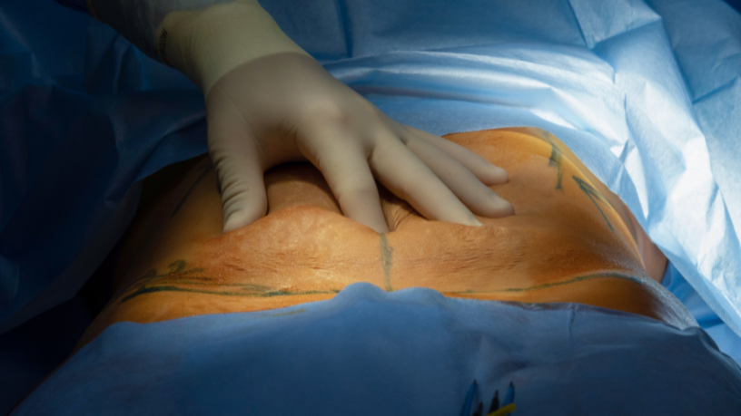 Saiba com Dr. Milton Seigi Hayashi como prevenir e tratar necroses após abdominoplastia.
